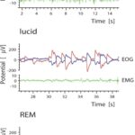 Eye movement signals (EOG) and electromyographic activity (EMG) in waking with eyes closed (WEC), during lucid dreaming, and during REM sleep. EOG refers to 2 channels, one from each eye, as indicated by separate colors. Eyes are moved to the left (L), right (R), left (L), and back to a central position (C). Eye movements in lucid dreaming are systematic, repetitive, and more pronounced than in REM sleep. Low EMG tracings are found in lucid dreaming and REM sleep, highlighting the muscle relaxation common to both states. Mean EMG amplitude for lucid dreaming and REM sleep showed no systematic variability between the 2 states. Subject 1 gave 3 repetitive eye signals. Subjects 2 signalled 4 times and subject 3 three times repetitively.