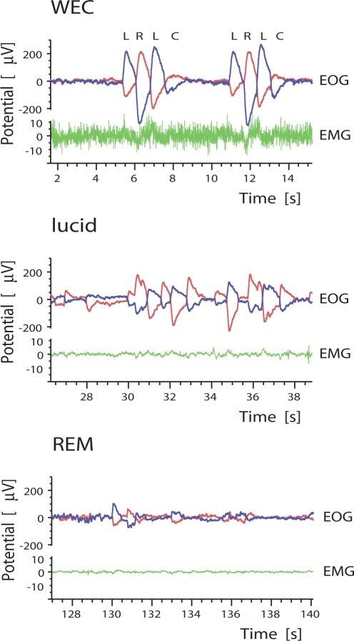 Eye movement signals (EOG) and electromyographic activity (EMG) in waking with eyes closed (WEC), during lucid dreaming, and during REM sleep. EOG refers to 2 channels, one from each eye, as indicated by separate colors. Eyes are moved to the left (L), right (R), left (L), and back to a central position (C). Eye movements in lucid dreaming are systematic, repetitive, and more pronounced than in REM sleep. Low EMG tracings are found in lucid dreaming and REM sleep, highlighting the muscle relaxation common to both states. Mean EMG amplitude for lucid dreaming and REM sleep showed no systematic variability between the 2 states. Subject 1 gave 3 repetitive eye signals. Subjects 2 signalled 4 times and subject 3 three times repetitively.