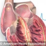 Atrial fibrillation (AFib) illustration showing irregular electrical signals in the atria leading to a quivering heart rhythm.