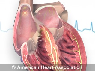 Atrial fibrillation (AFib) illustration showing irregular electrical signals in the atria leading to a quivering heart rhythm.