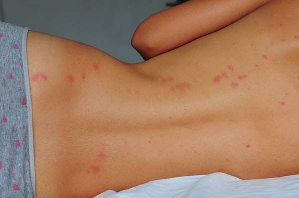 Close-up of bed bug bites on a woman's back, showing red, raised welts in a cluster