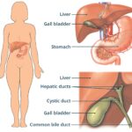 Gallbladder Location in the Upper Right Abdomen:  Anatomical illustration showing the gallbladder situated beneath the liver on the right side of the upper abdomen, highlighting its position relevant to understanding gallbladder pain and cholecystitis.