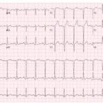 EKG showing sinus tachycardia