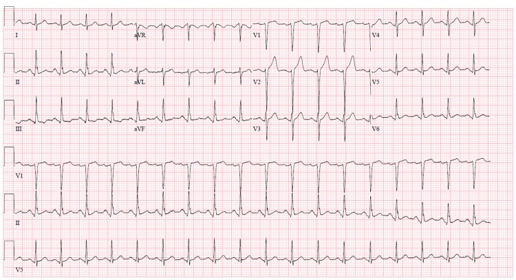 EKG showing sinus tachycardia