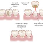 Illustration of a dental crown procedure.