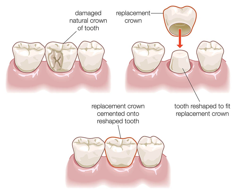 Illustration of a dental crown procedure.