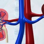 kidney disease