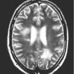 Brain MRI scan