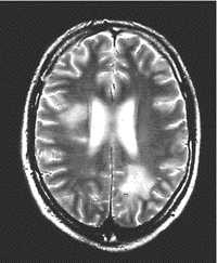 Brain MRI scan