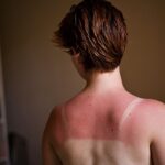 Person with visible sunburn marks on their back illustrating the dangers of excessive sun exposure without adequate protection