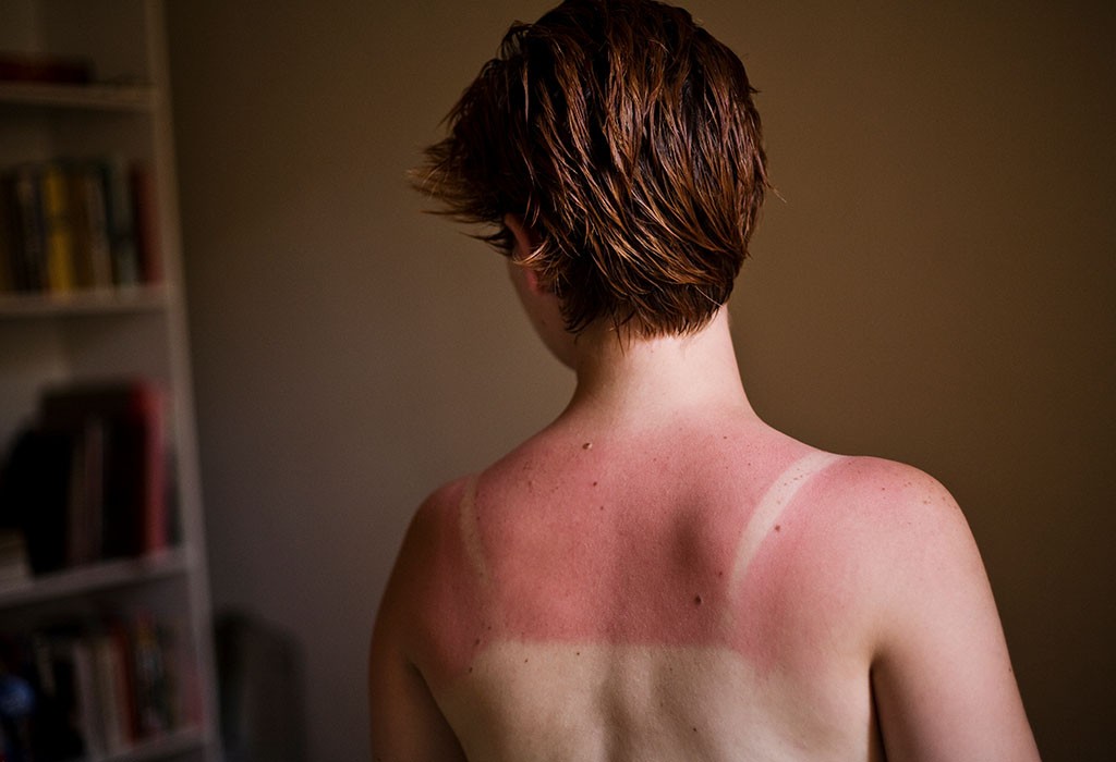 Person with visible sunburn marks on their back illustrating the dangers of excessive sun exposure without adequate protection