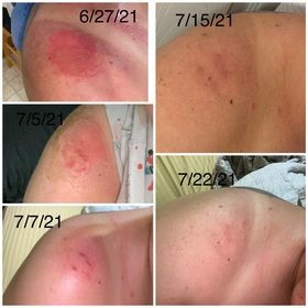 Body Butter and Sunburns