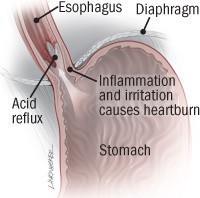 Esophagus and stomach showing inflammation from GERD