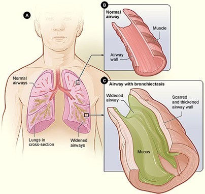 X-ray image of lungs, highlighting bronchiectasis-affected airways