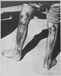 Atomic Burns from Hiroshima Blast